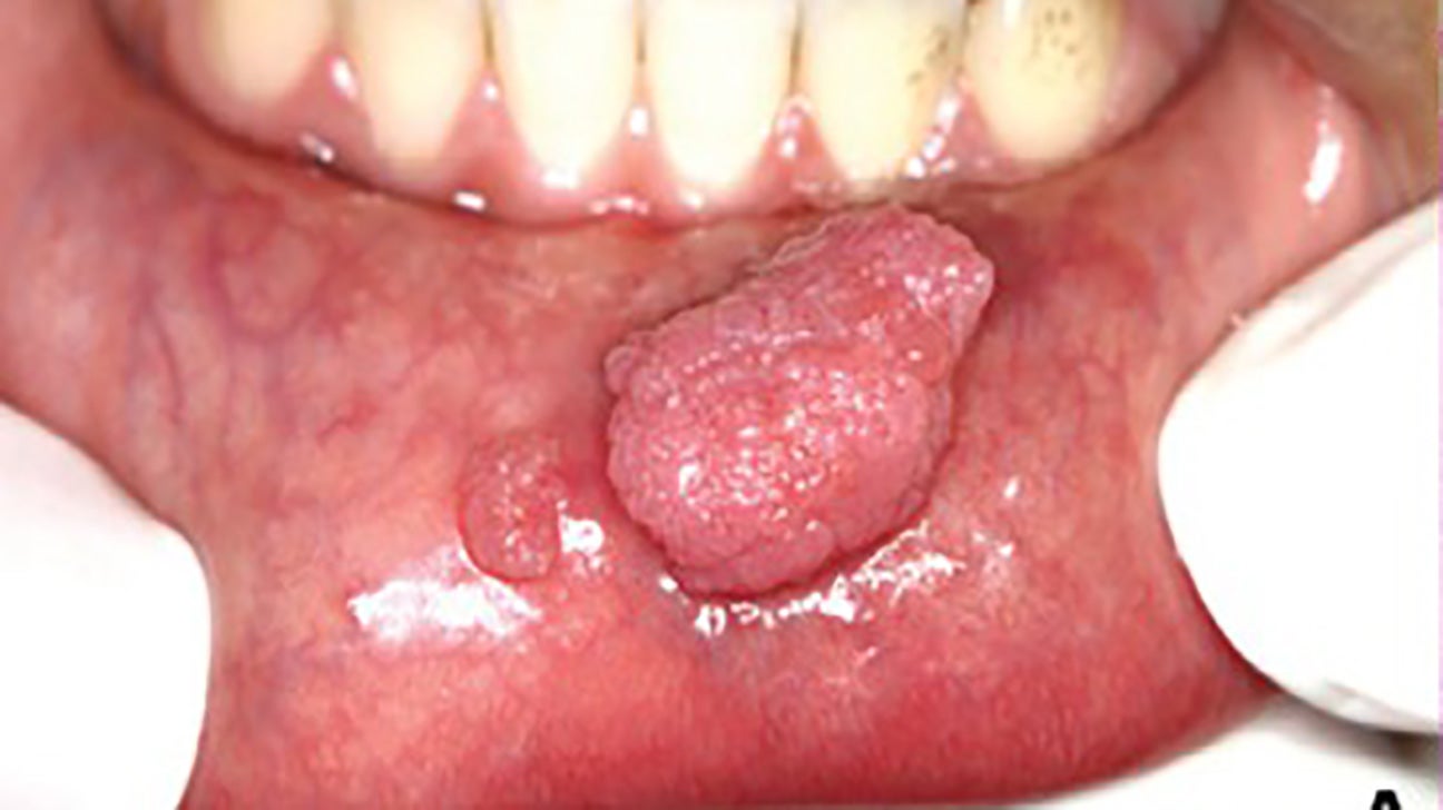 hiv symptoms on lips