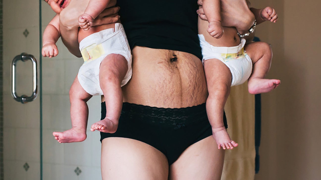 If that Post-Baby Bulge Won't Budge, a Tummy Tuck May Help