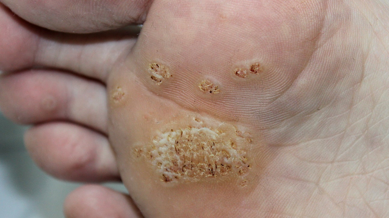 foot wart types