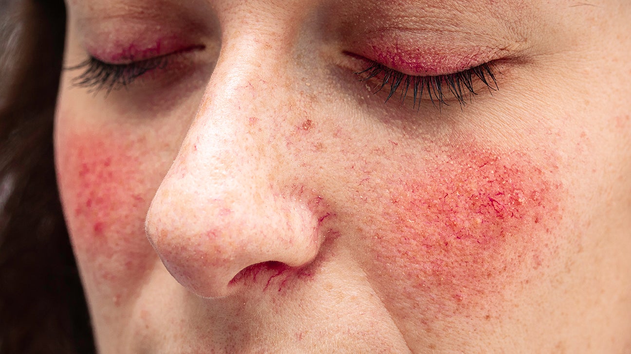 Rosacea Treatments Types Causes And Symptoms