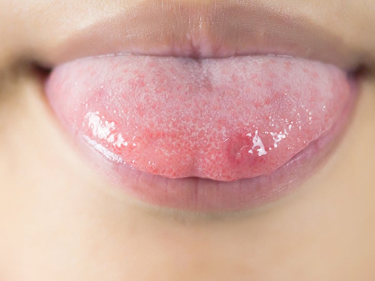 ehat causes sores ontour tongue