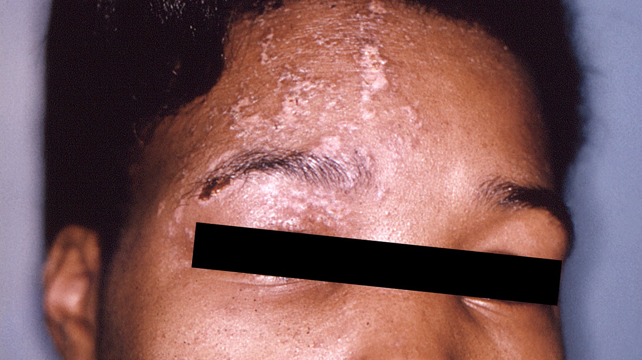 hives on black people skin