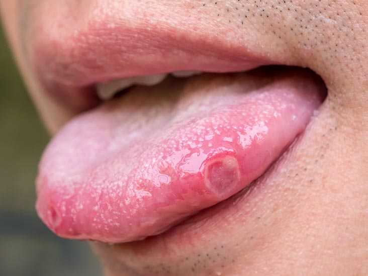 stress bumps on tongue