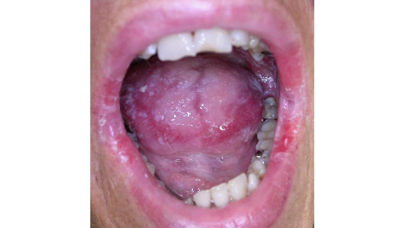 Blister small tongue clear under Causes of