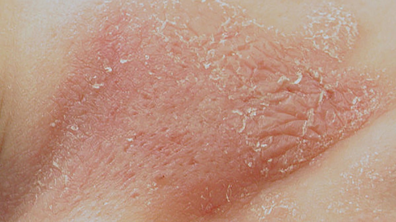 Rash where the seam of my underwear is? It's itchy. : r/medical_advice