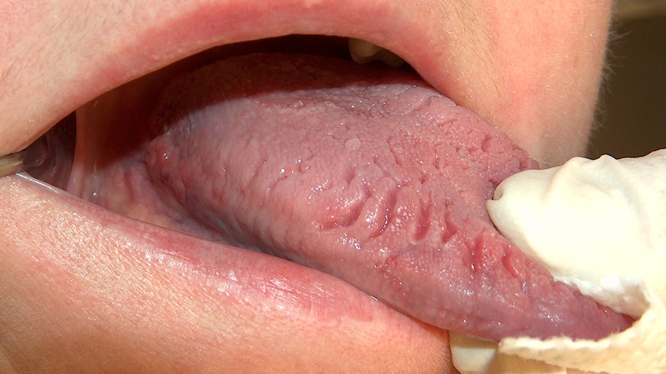Healing split tongue 