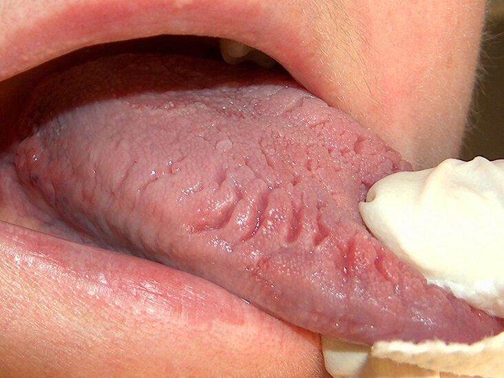 Tongue small ball under Bump under