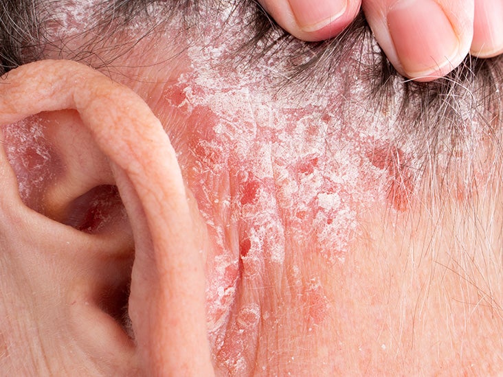 psoriasis behind ears weeping vörös foltok kezelése pattanások után