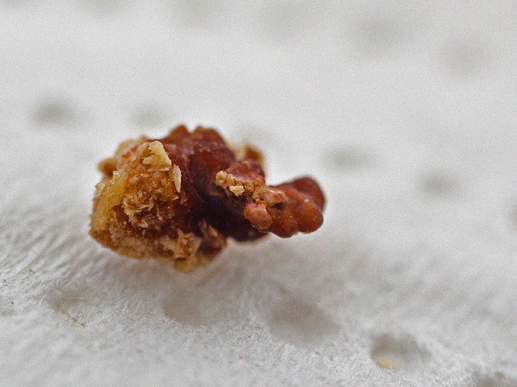 Kidney Stones Pictures Visuals Symptoms And Treatment