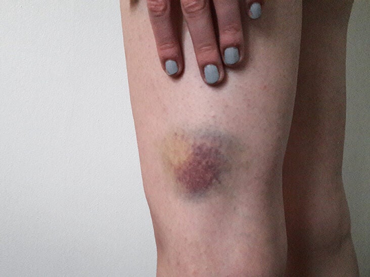 ærme genopretning Mælkehvid Unexplained bruising on the legs: What causes it? Is it treatable?