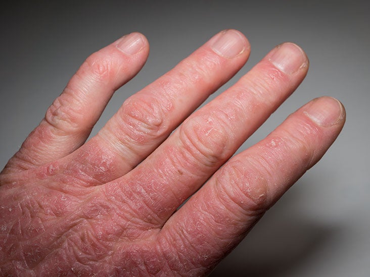 Psoriatic Arthritis Symptoms Causes Treatment And Outlook
