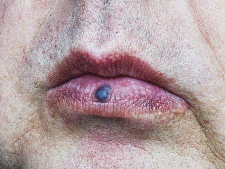 Spot On Lip Causes Symptoms And Treatment