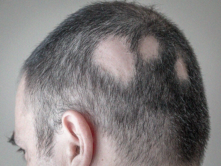 Bumps On The Scalp Causes Symptoms And Treatments