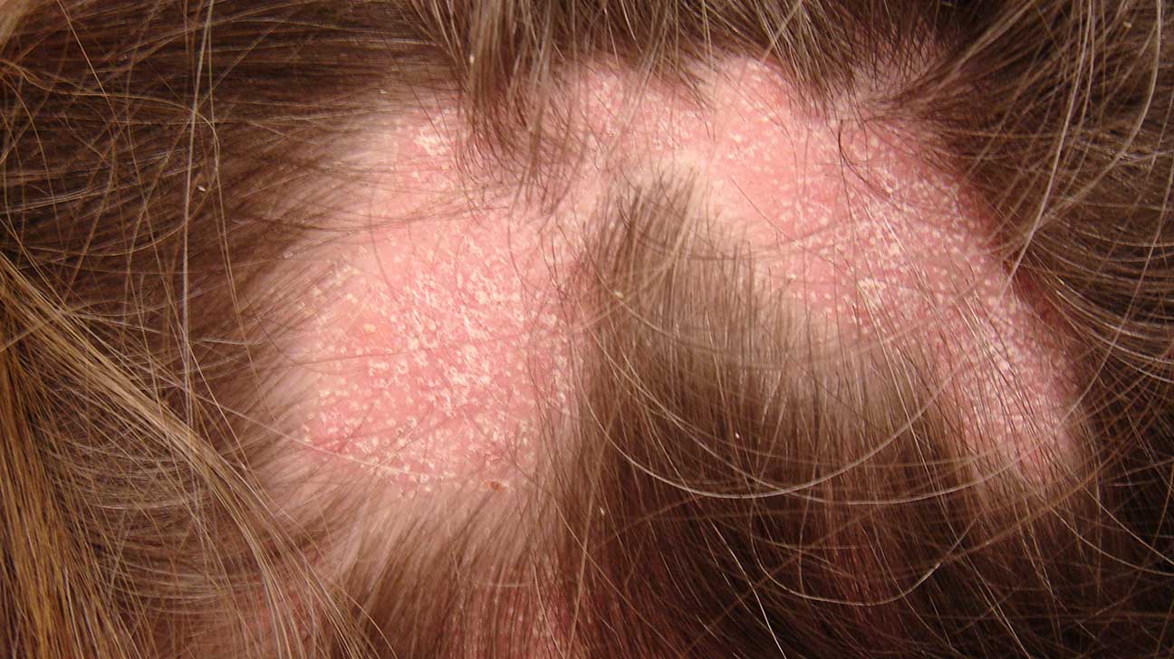 korn binding øje Red spots on scalp: Pictures, causes, and treatments