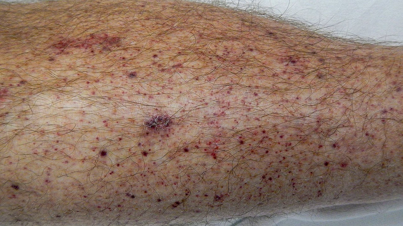 Bruises legs sex on 5 ways