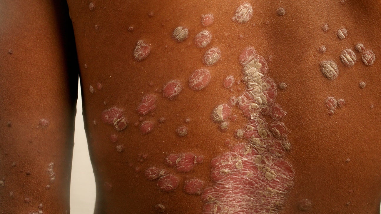 heat rash on african american skin