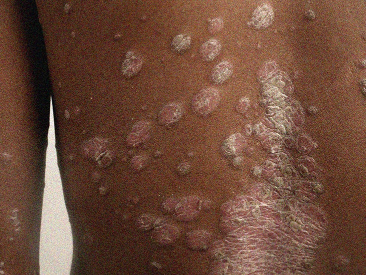 Rash On Black Skin Pictures Symptoms And Treatments