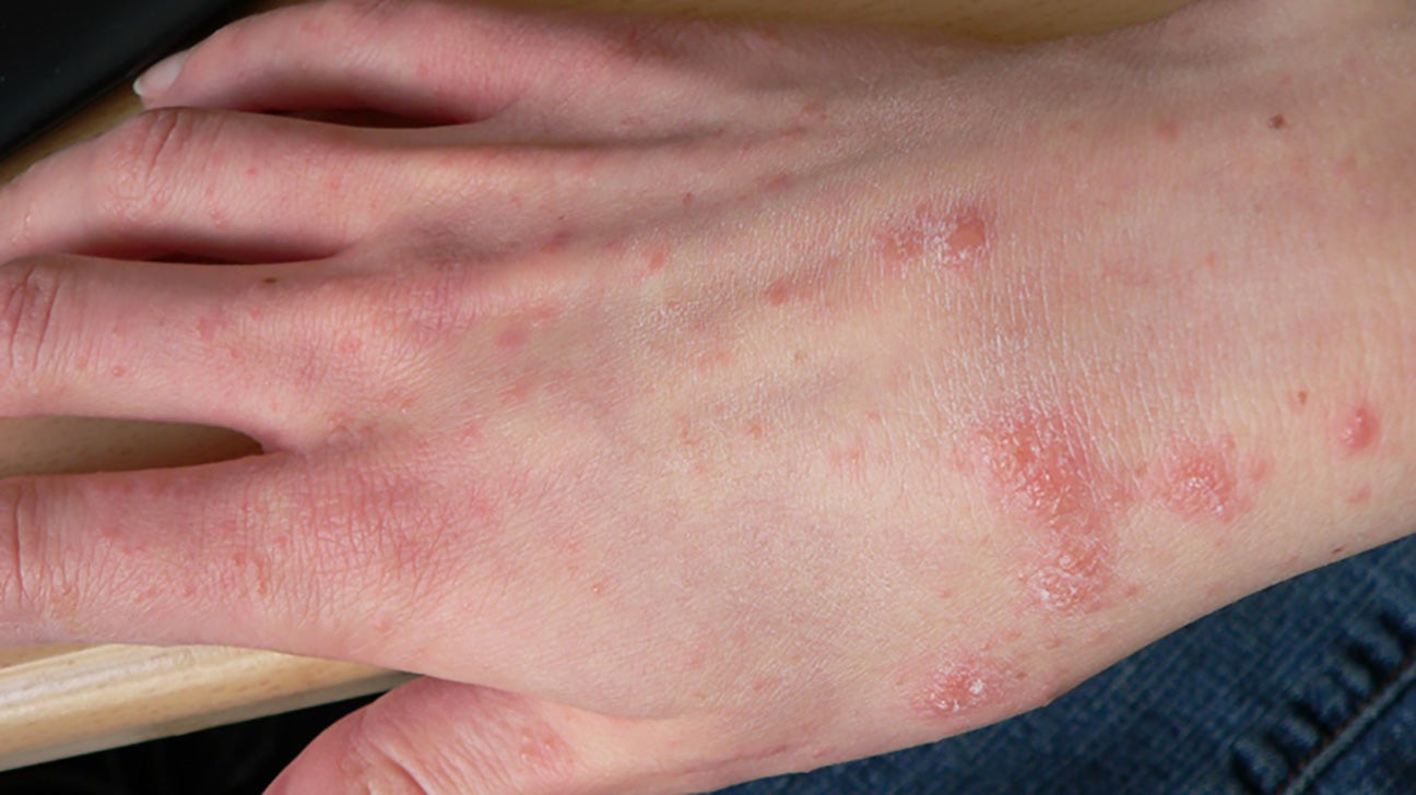 Scabies in Children: How to Care for a Child with Scabies - Care Options  for Kids