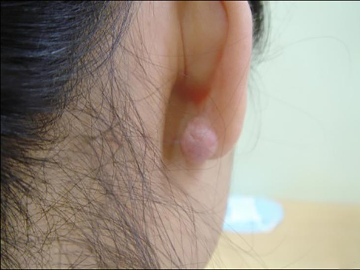 Lump Behind Ear Infected Piercing At Harris Gilmore Blog