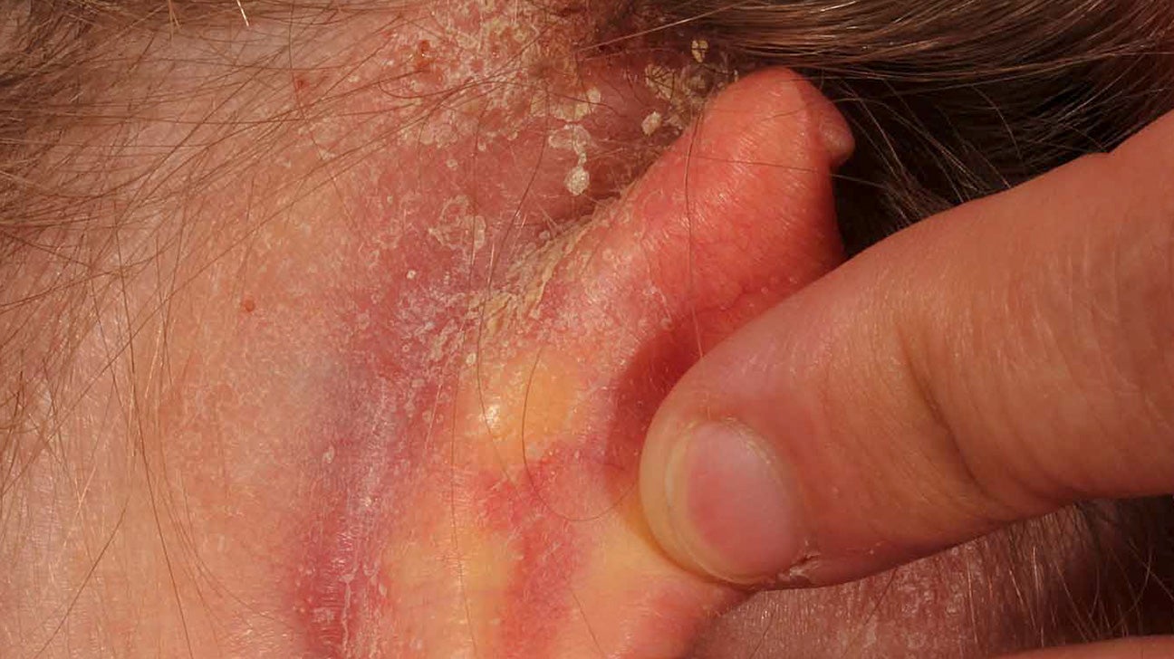 psoriasis behind ears and neck)