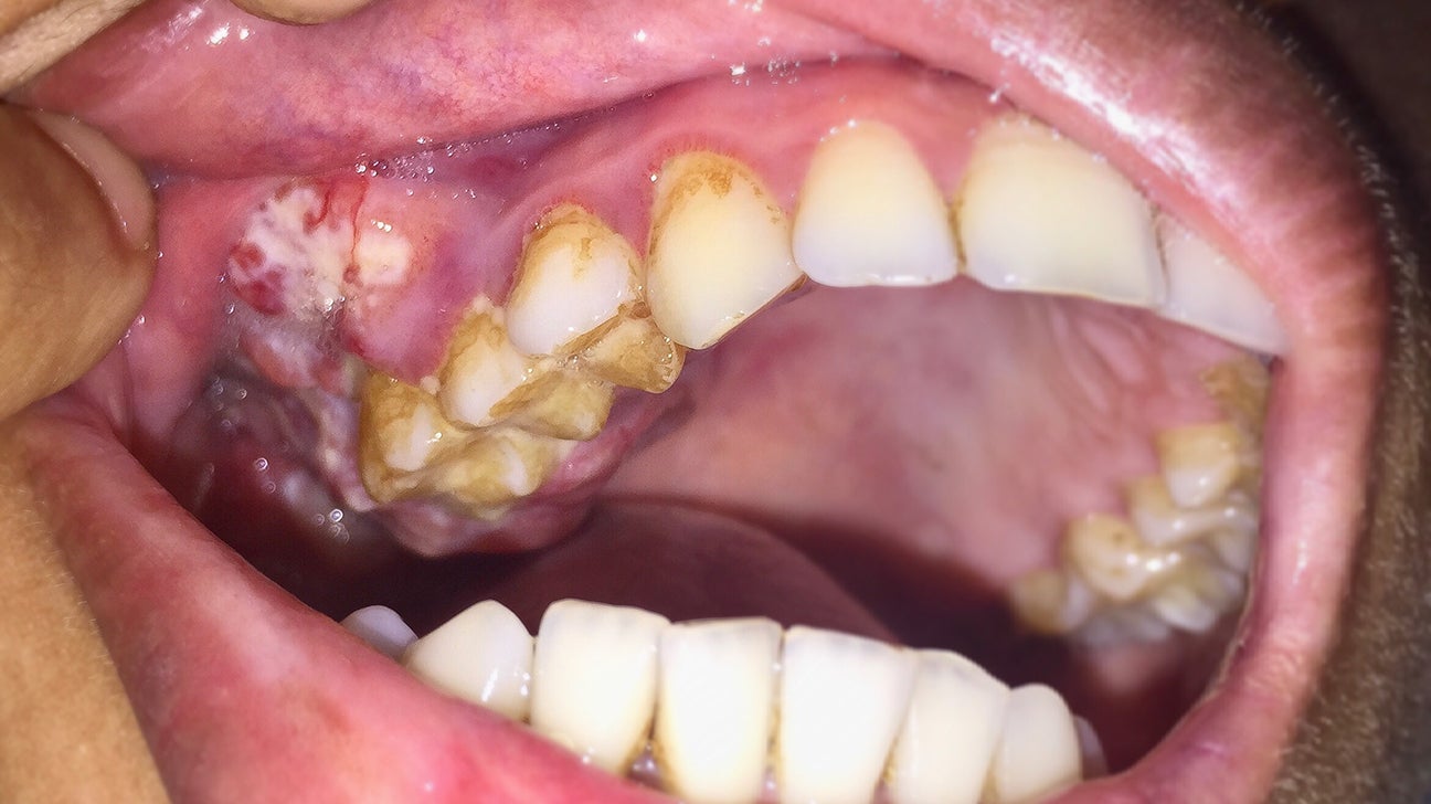 oral cancer under tongue