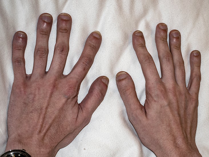 Clubbed fingers: Causes, symptoms, treatment, and when to seek help