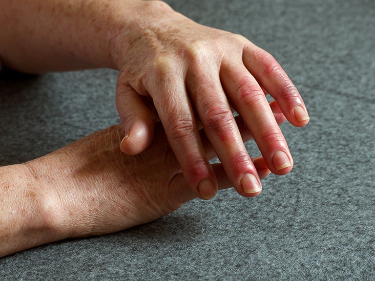 Arthritis in fingers What does it feel like? Causes and treatment