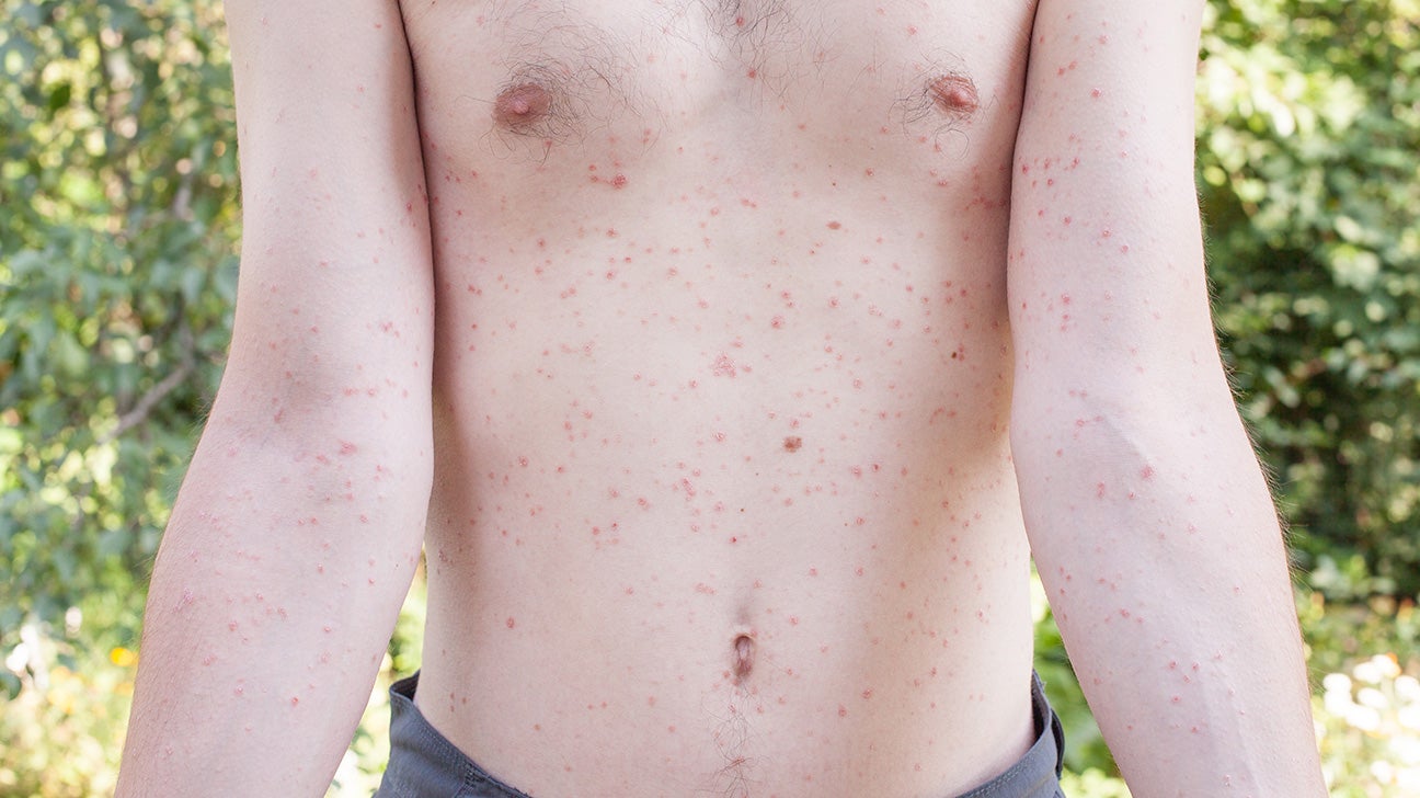 Scarlet Fever Rash  YourCareEverywhere