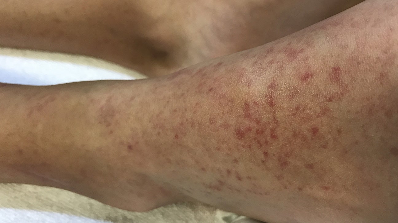 Sand paper' rash in scarlet fever