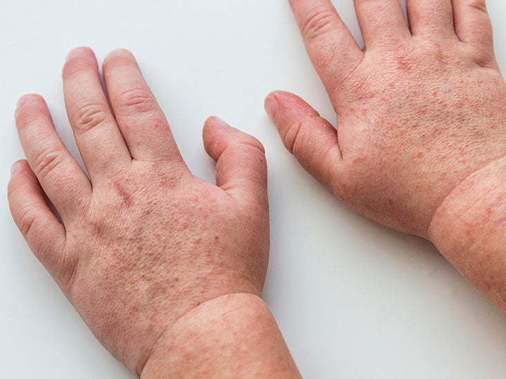 Scarlet Fever Rash Symptoms Diagnosis And Treatment