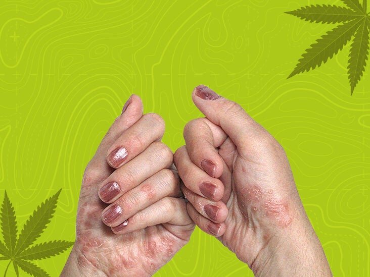 Tålmodighed engagement lyserød 3 of the best CBD oils for psoriasis: Products and more
