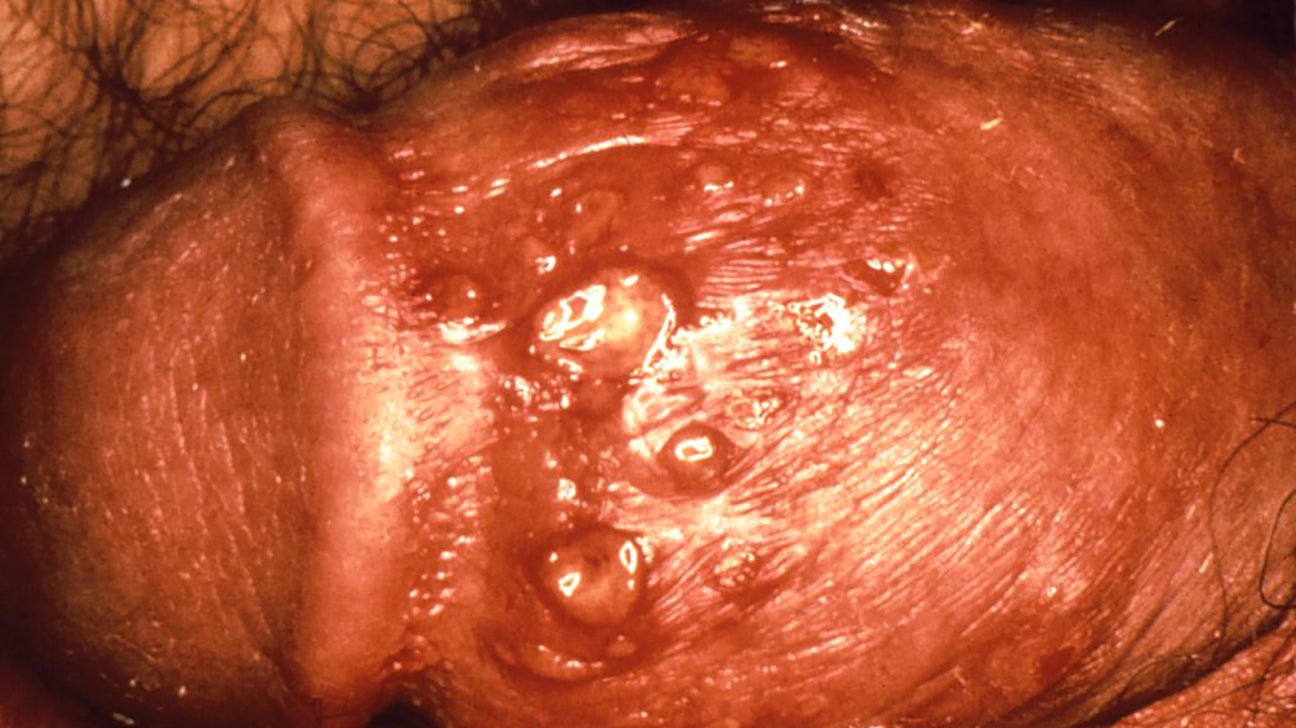 Mann herpes bilder genitalis Genitalherpes: Was