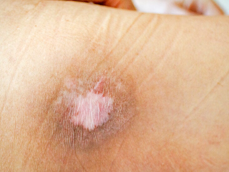 Skin Lesions: Pictures, Causes, Diagnosis, Treatment & More