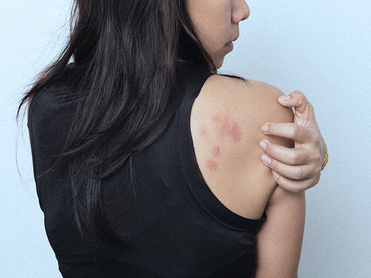 Itchy bumps on skin like bites: What