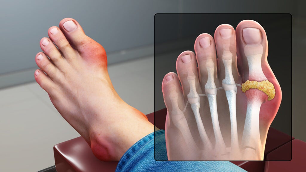 Gout In Big Toe How To Identify Causes And Treatment