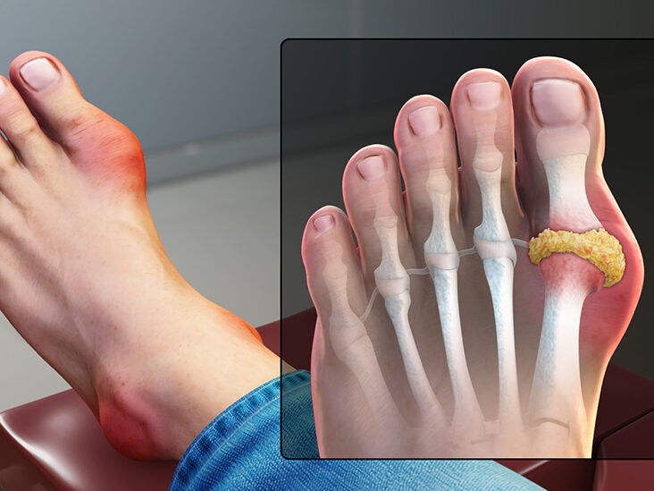 Rheumatoid arthritis vs. gout: What's the difference?