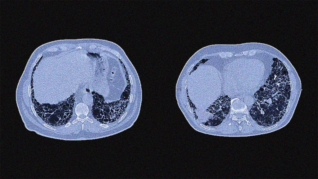 Idiopathic Pulmonary Fibrosis: Definition, Symptoms, And Treatment