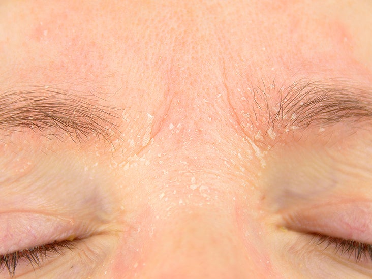 eczema on eyebrows