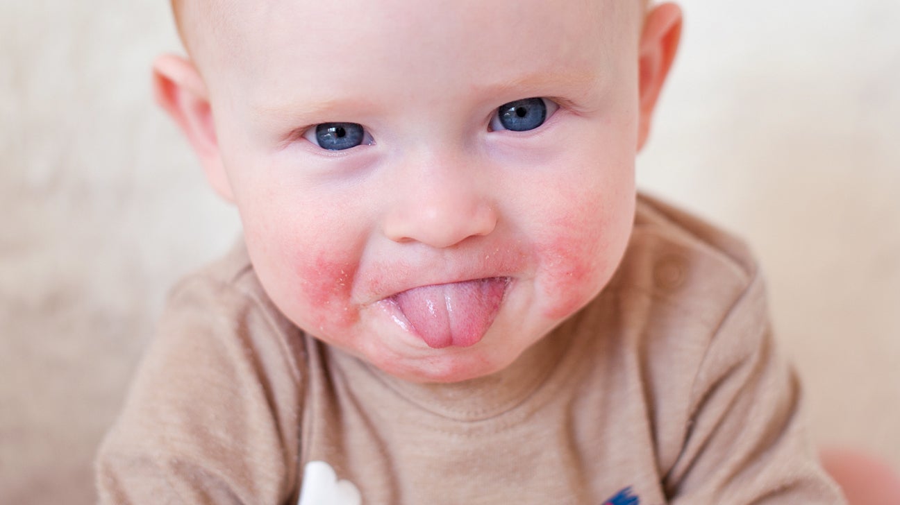 How to treat rash on baby face from saliva