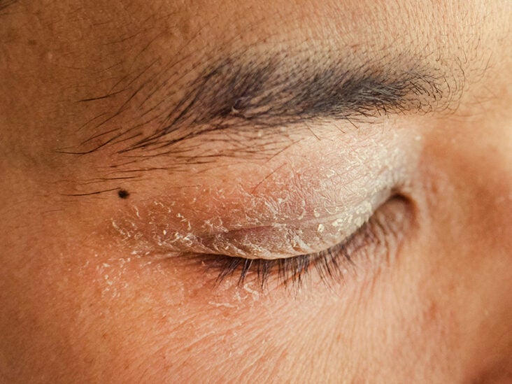 How To Get Rid Of Dark Spots On Eyelids 