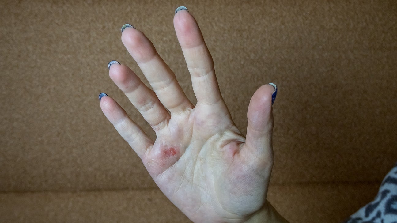 mængde af salg Stort univers Ond Palm rash: Causes, pictures, and treatments