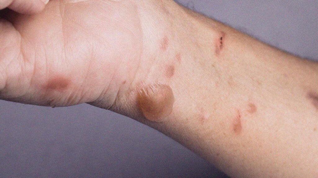 Large Itchy Bumps On Skin