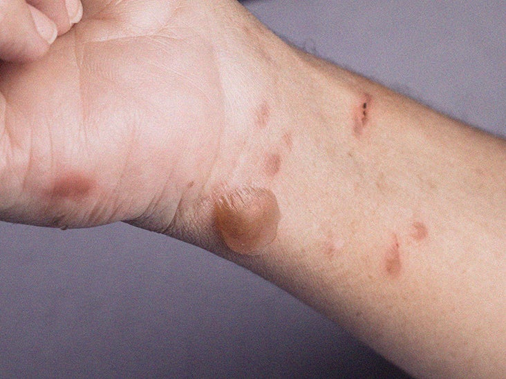 Itchy Bumps Filled With Clear Liquid Causes And Treatment