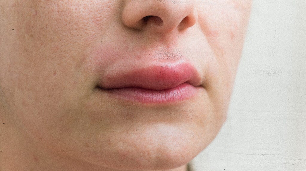 Swollen upper lip Causes and treatments