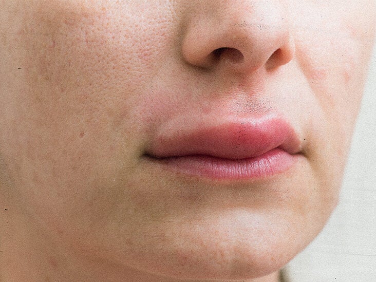 Swollen upper lip: Causes and treatments