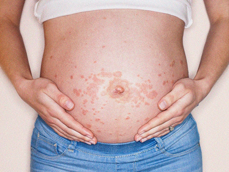 Itchy Rash On Skin During Pregnancy