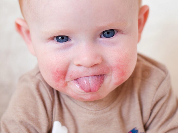 Red rash on baby cheeks and ears