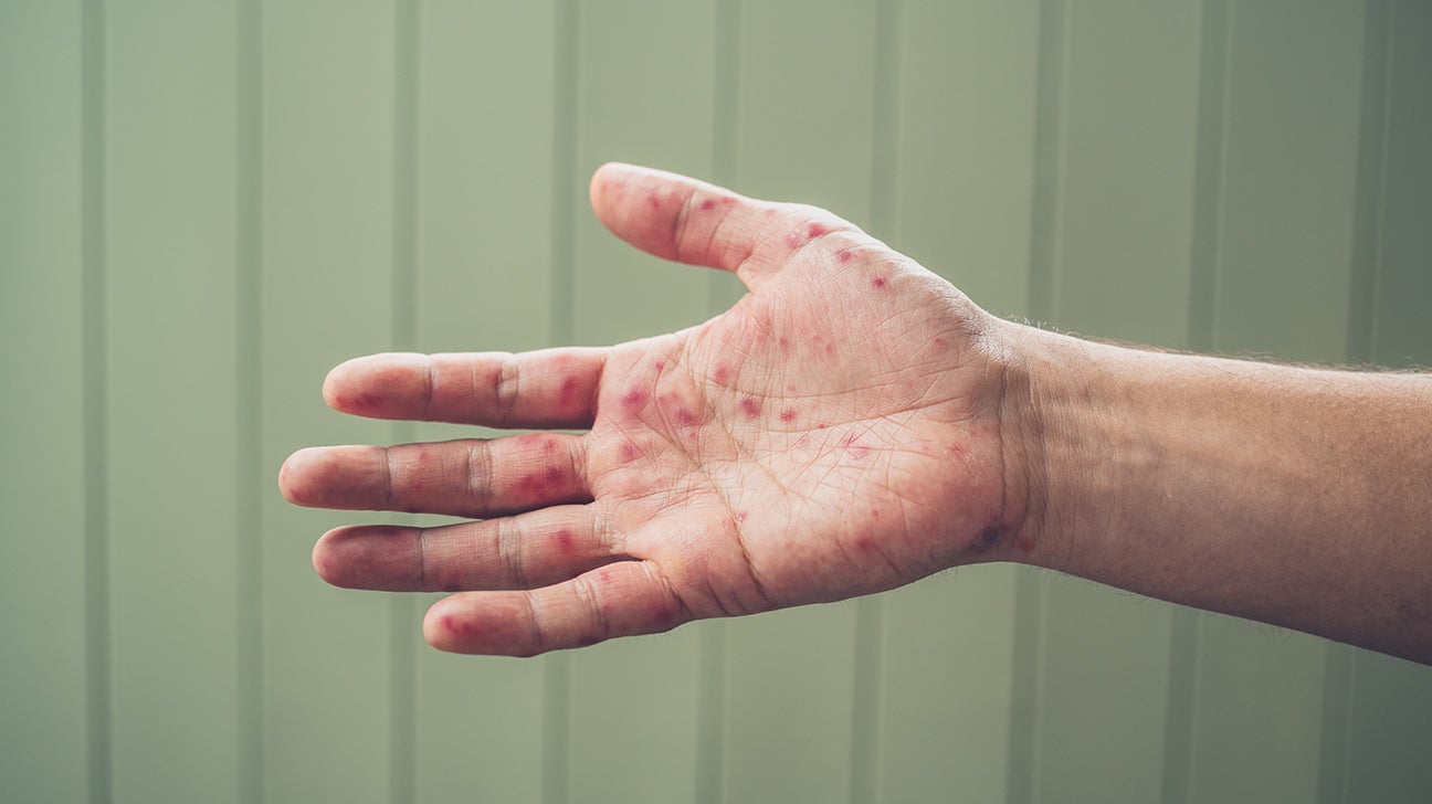 Allergic reaction red bumps on hands