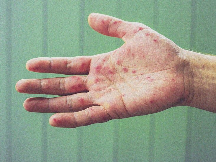 Poison Ivy Rash On Palms