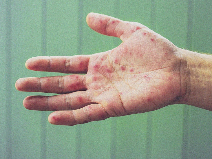 types-of-rashes-on-palms